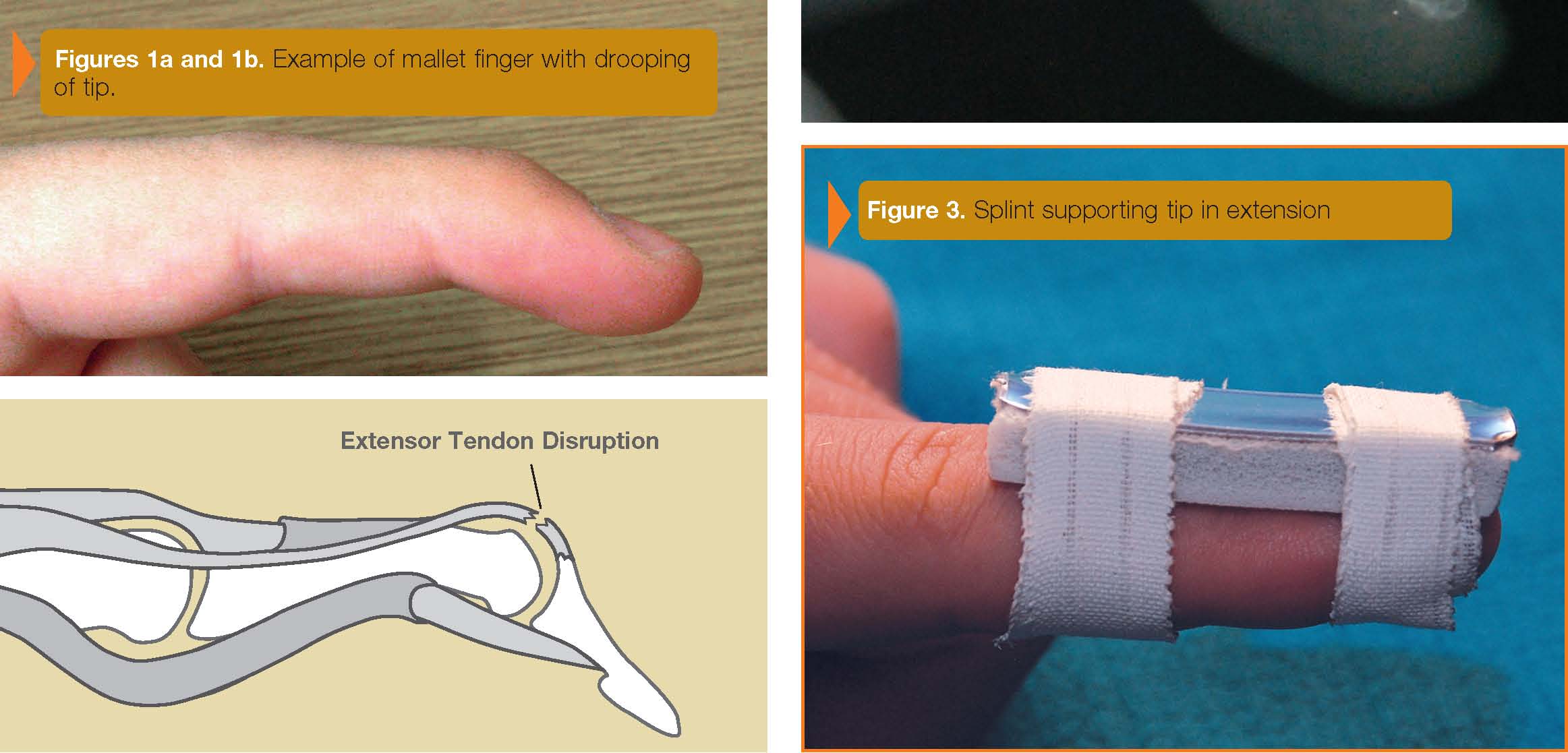 mallet finger symptoms